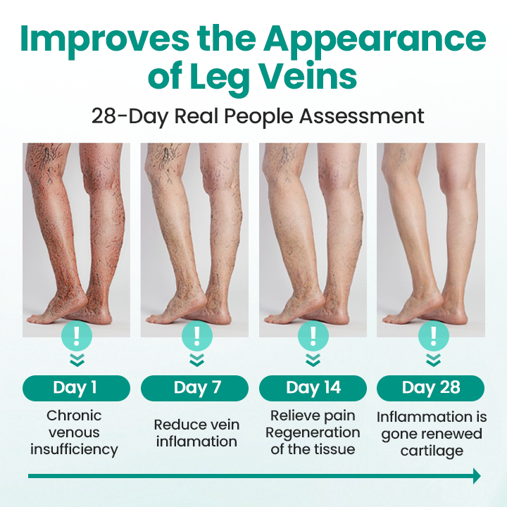 LBMLBM™ LegRenew Varicose Veins Patch