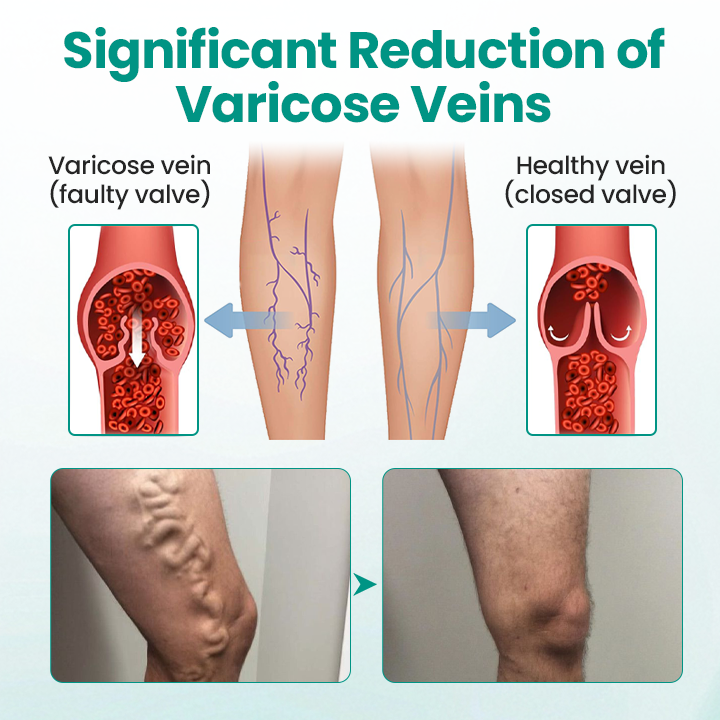 LBMLBM™ LegRenew Varicose Veins Patch